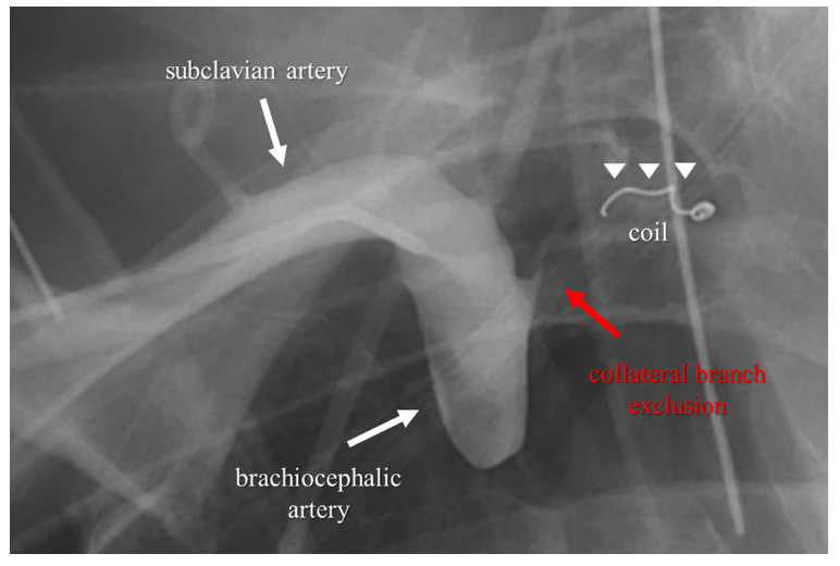 Coil Embolization for Complications Following PCI JIC